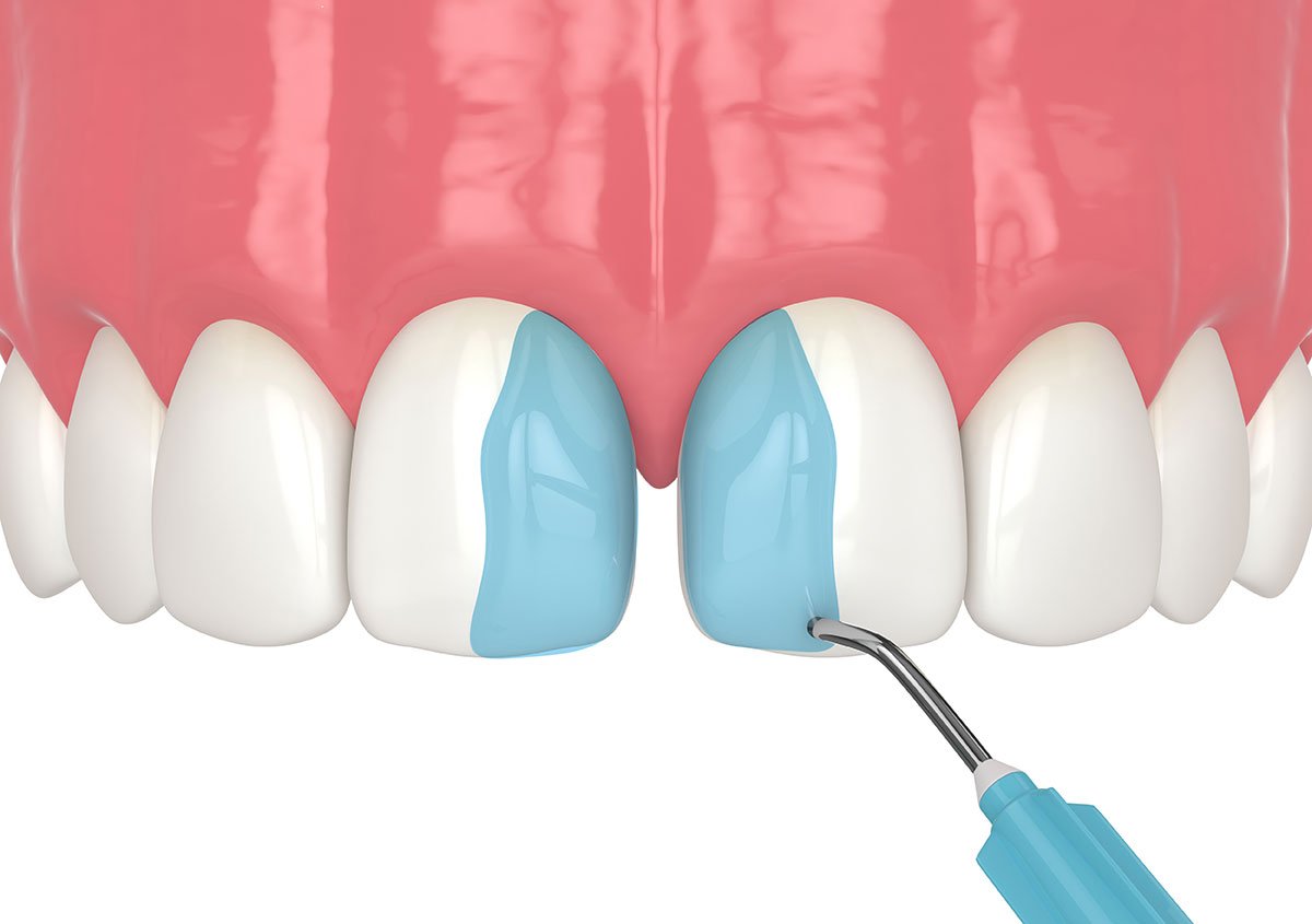 Dental-Bonding image