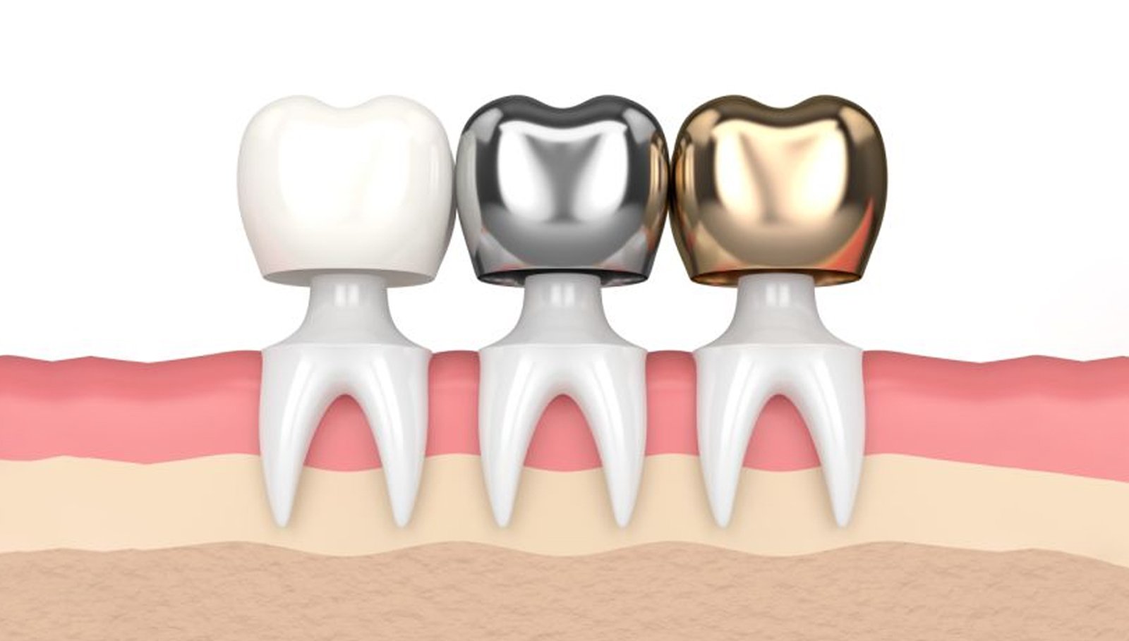 Dental-Crowns