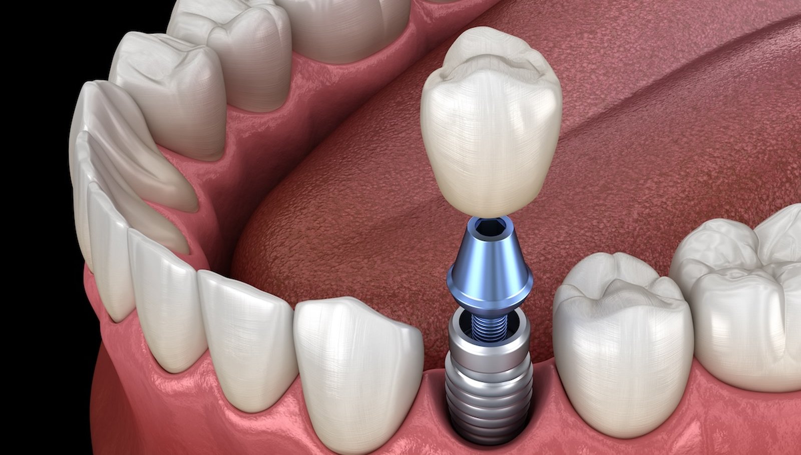 Dental-Implants