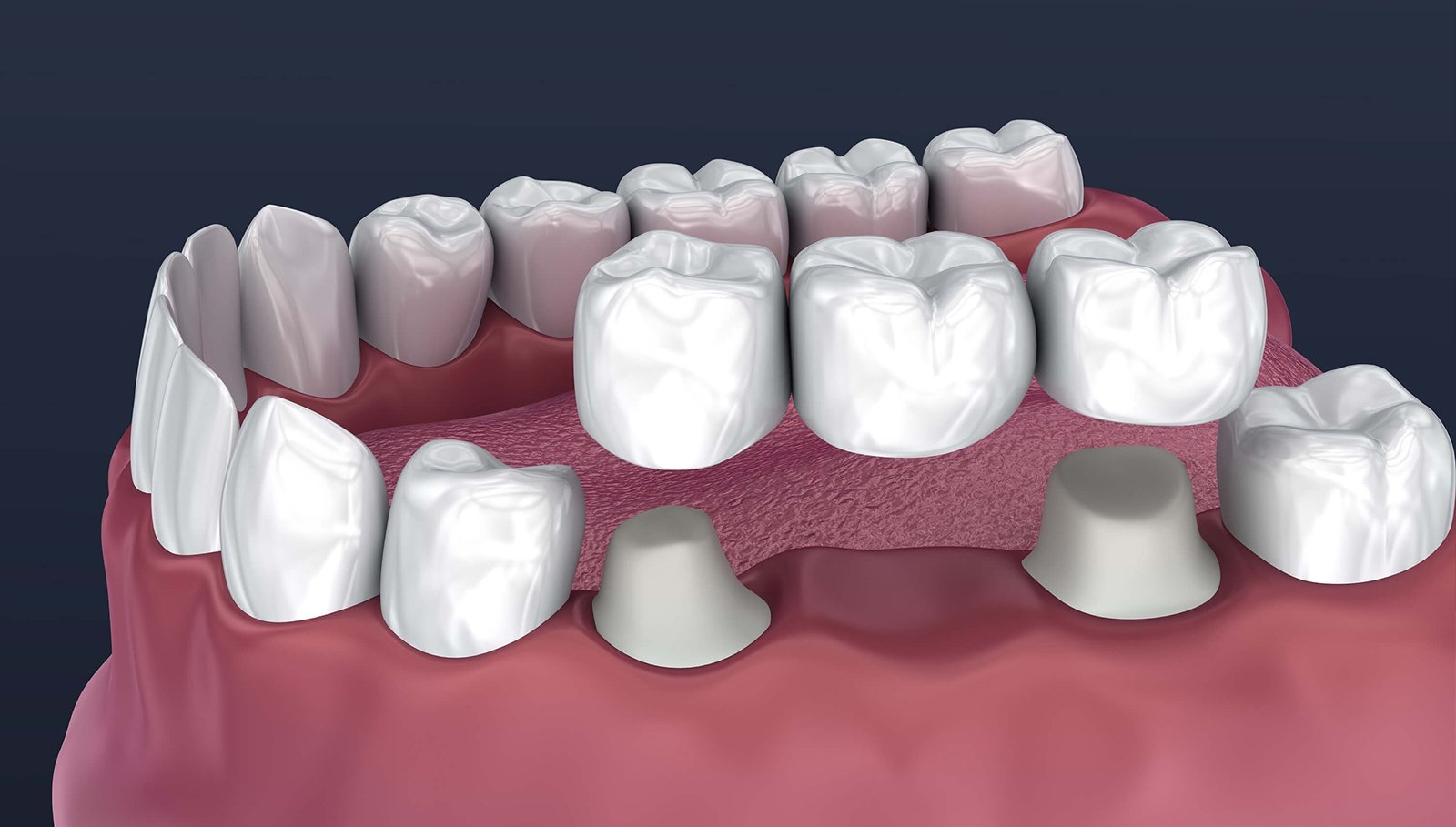 Fixed Dental Bridges Clean Bite Dentistry