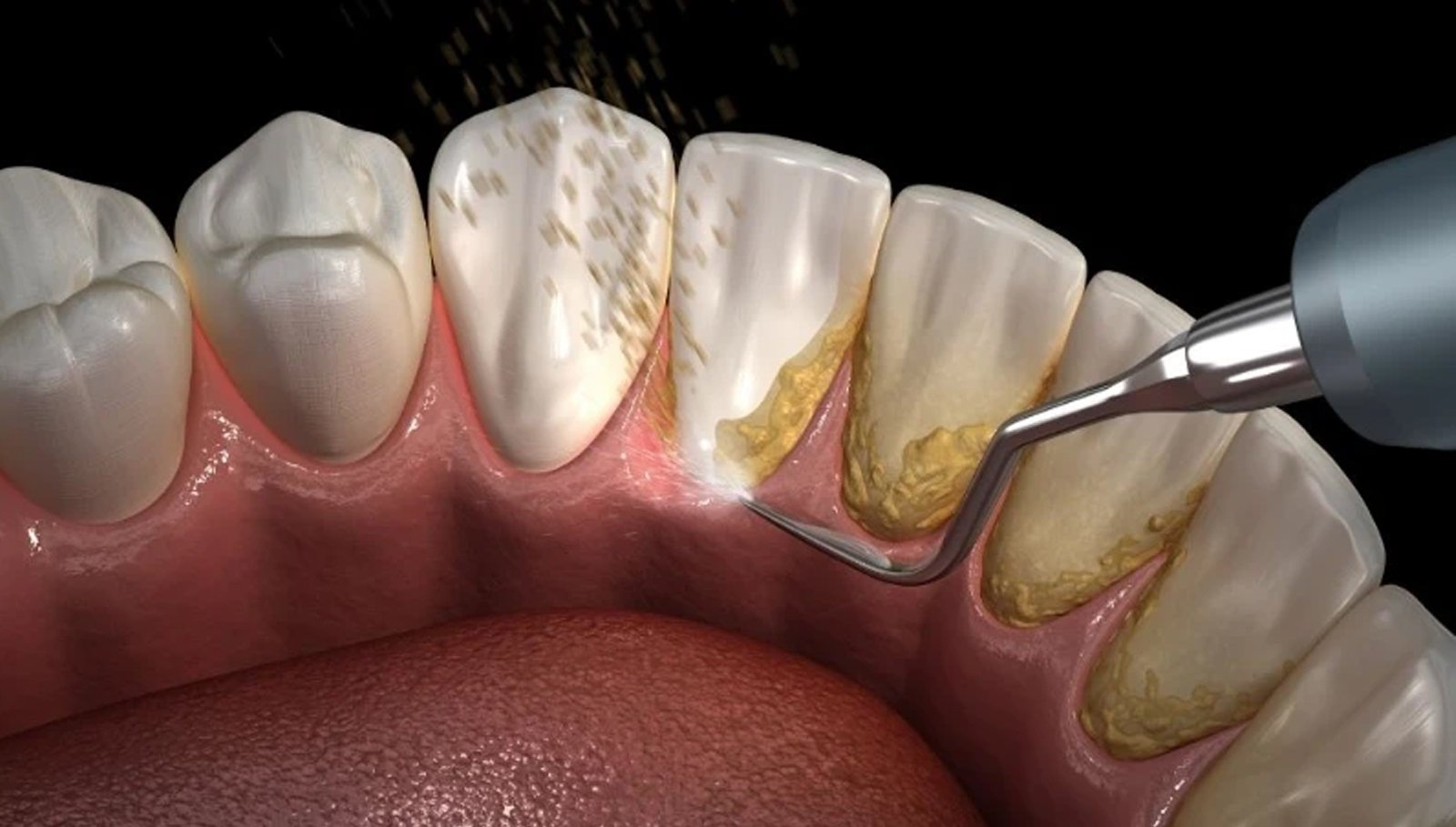 Periodontal-Scaling