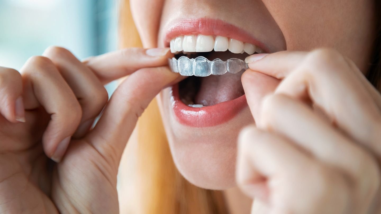 Orthodontics at Clean Bite Dentistry